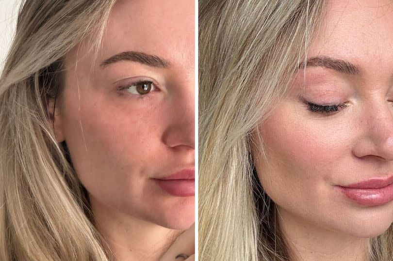 Left, Zoe before the Nefertiti lift and Teoxane filler, and right, two weeks after