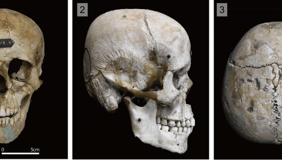在廣田遺址發現的一具大約1800年前的個體的頭顱，其後部有明顯的扁平化特徵。（圖／Seguchi et al., PLOS ONE, cc BY 4.0）