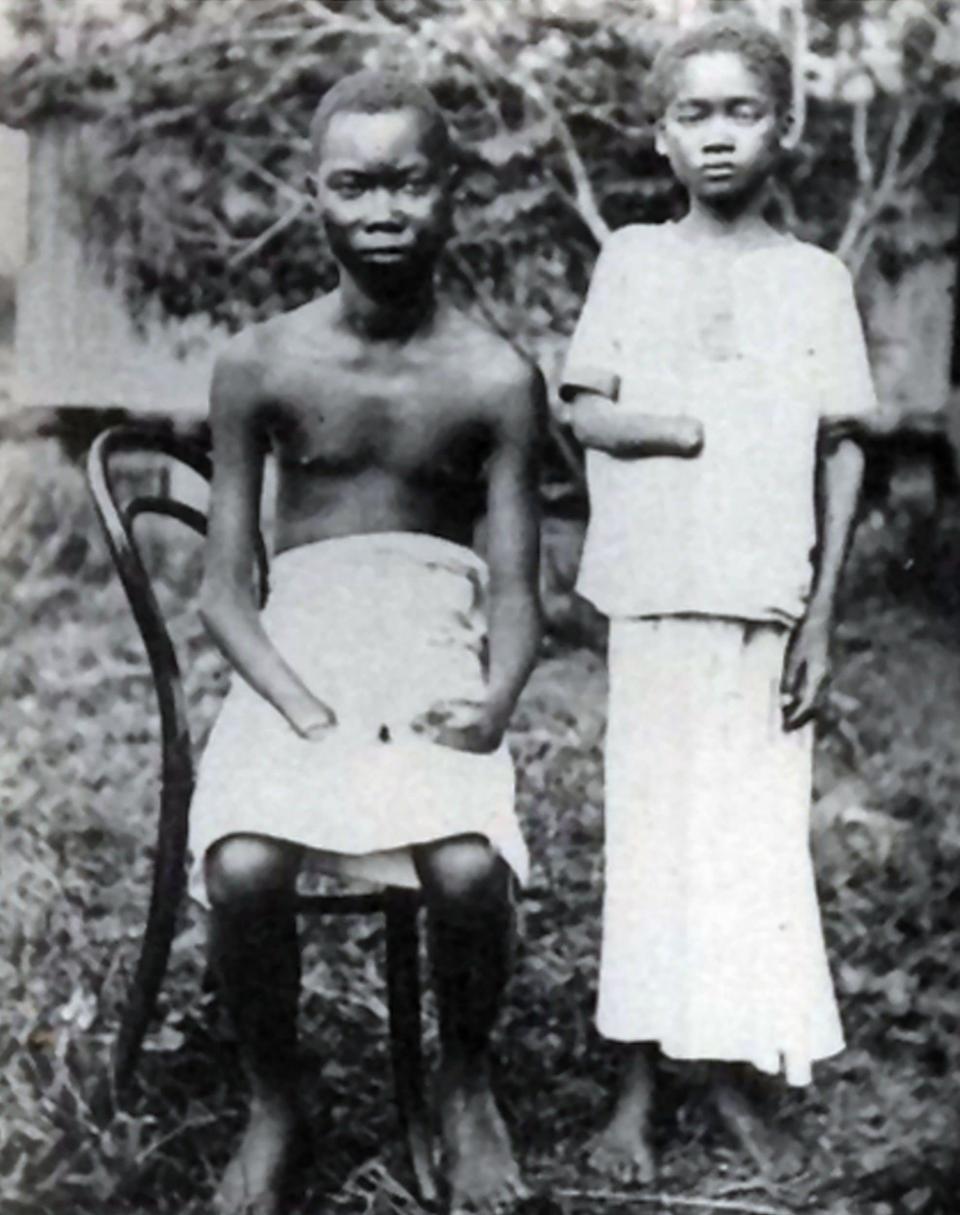 Amputation was frequently used to punish workers in the Congo Free State - Universal History Archive /Universal Images Group Editorial 