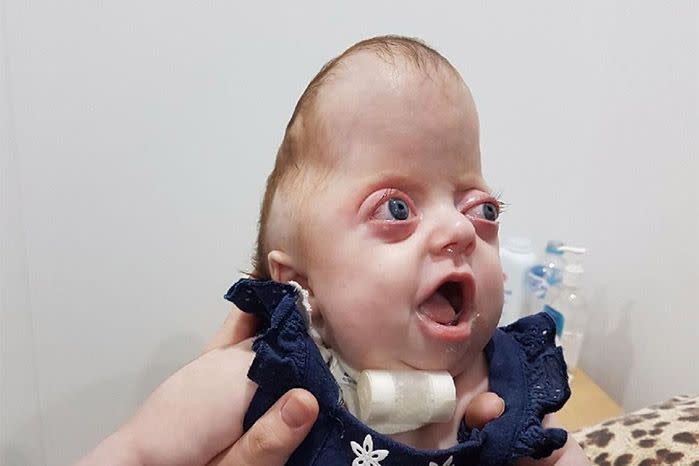 Pfeiffer Syndrome is thought to affect just one in 100,000 people. Source: GoFundMe
