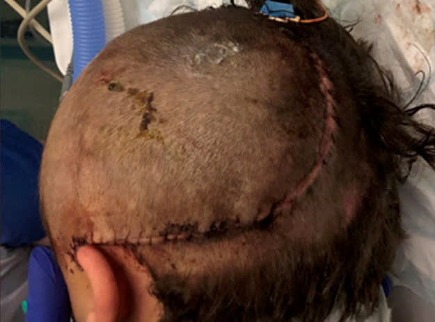 The victim's scar after surgery. See SWNS story SWMDbat, An 18-year-old has today been jailed for a vicious attack on a boy that left him severely disabled.  On November 13, 2018 we were called to reports that a 16-year-old boy had sustained a serious head injury after being assaulted earlier that evening in Middleton-by-Wirksworth. The teenage boy, who is now 17, remained in hospital for nine months and although he is now at home he requires full-time care and has a lifelong brain injury.  John Callis-Woolsey from Middleton-by-Wirksworth previously pleaded guilty to causing grievous bodily harm with intent and was today sentenced to eight years in jail at Derby Crown Court.   