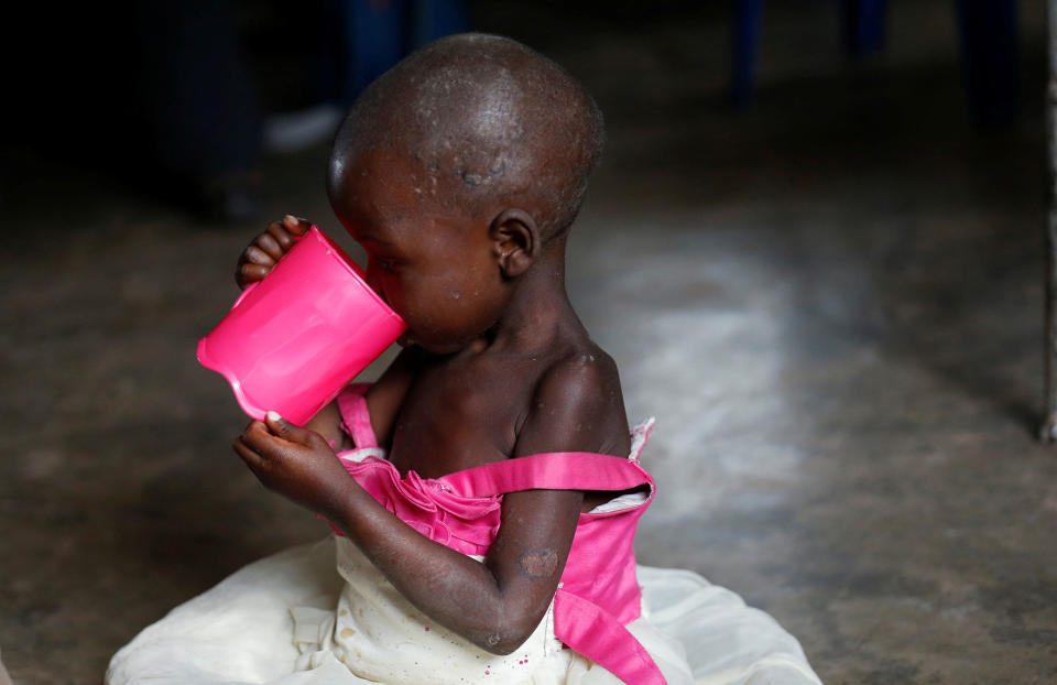 <p>A severely acute malnourished and internally displaced Congolese child drinks porridge as she waits to receive medical attention at the Tshiamala general referral hospital of Mwene Ditu in Kasai Oriental Province in the Democratic Republic of Congo, March 15, 2018. (Photo: Thomas Mukoya/Reuters) </p>