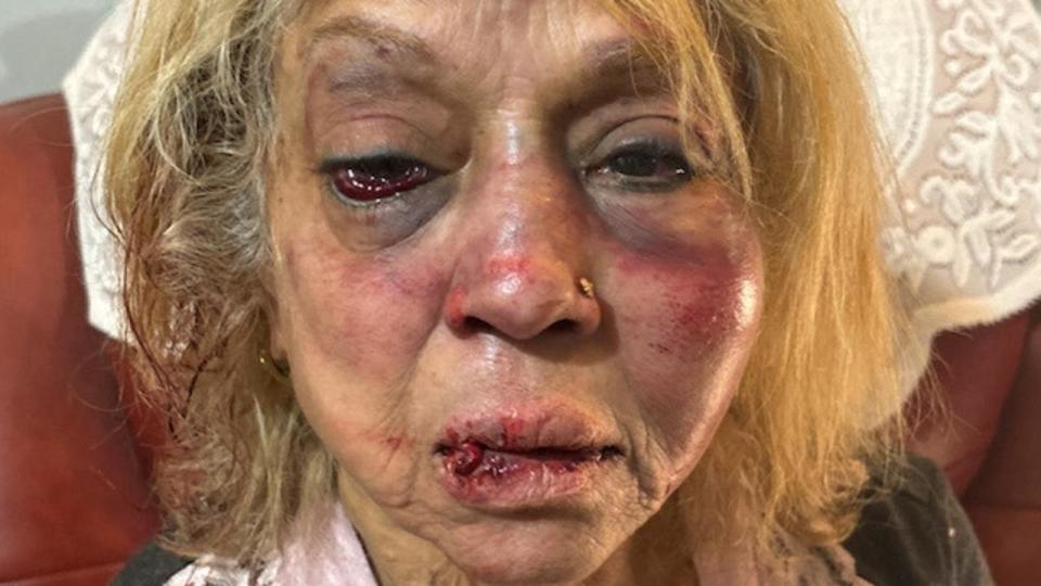 Ninette Simons received severe facial bruising and swelling after she was allegedly assaulted during a shocking home invasion at her Girrawheen home earlier this month. Picture: WA Police/Supplied