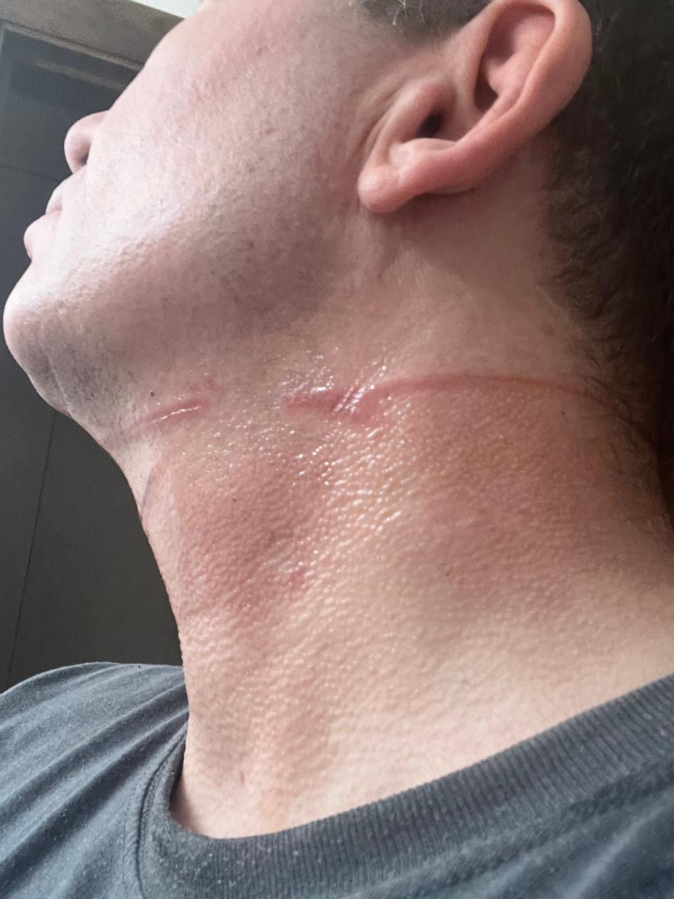 Ronald Ekker said a long, thin wire struck his neck while he was biking along Lincoln Memorial Drive in Milwaukee. The wire is part of an eruv, a perimeter of cables set up by an Orthodox Jewish group.