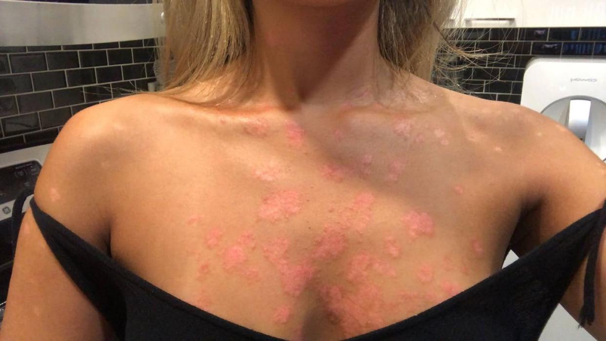 michelle lee tells women's health about her experience being diagnosed with plaque psoriasis