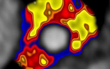 Standard CT scans show white lines on a black background, but CaRi-Heart throws up a cacophony of colours. Yellow is good, and indicates the walls of the arteries are calm. The more red and blue appears, the more distressed the vessel is