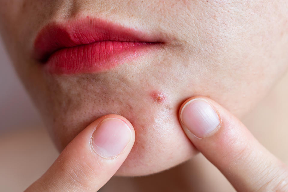 Inflamed acne consists of swelling, redness, and pores that are deeply clogged with bacteria, oil, and dead skin TikTok cells.