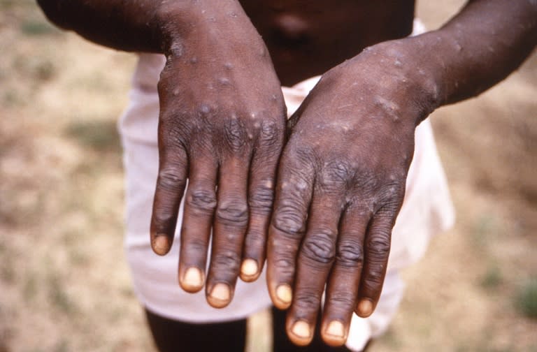 A person in DR Congo with a previous strain of mpox -- the new clade Ib is the "most dangerous so far," researchers warn (Brian W.J. Mahy)