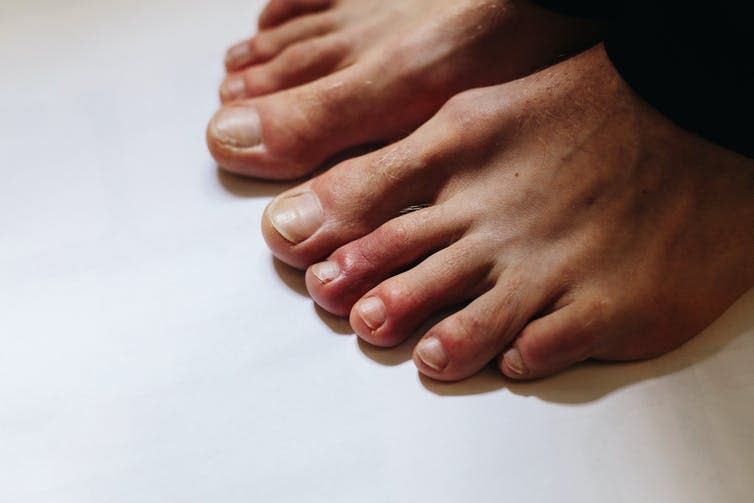 A person with COVID toes