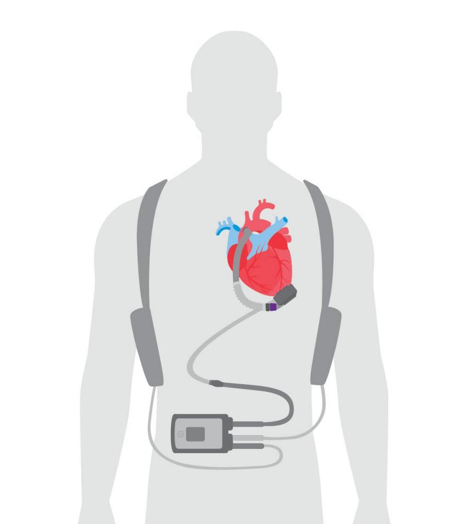 An illustration of how a left ventricular assist device is implanted at the bottom of your heart inside your chest and is attached to a line that connects it to a controller, which runs the pump with batteries.