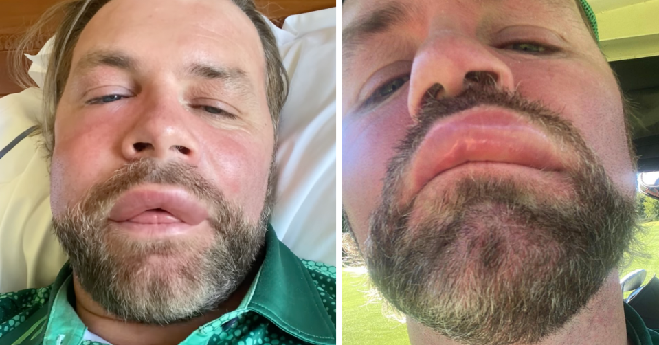 Brian McFadden's face blew up after he had a reaction to a bee sting. Source: Instagram