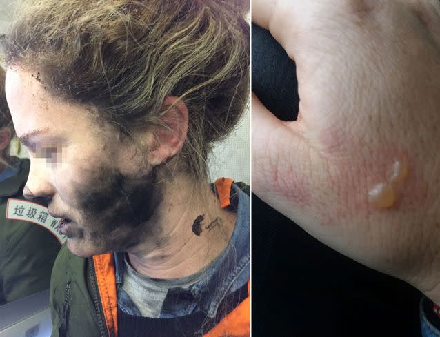 The woman was left with a burnt face, hair and hand. Source: ATSB