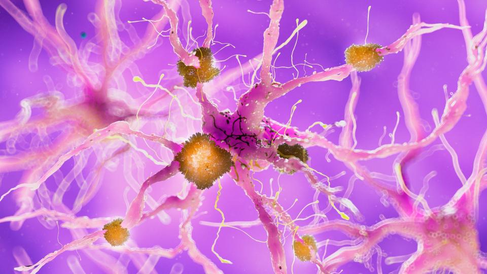 Medical illustration of a nerve cell in pink surrounded by amyloid plaques in yellow