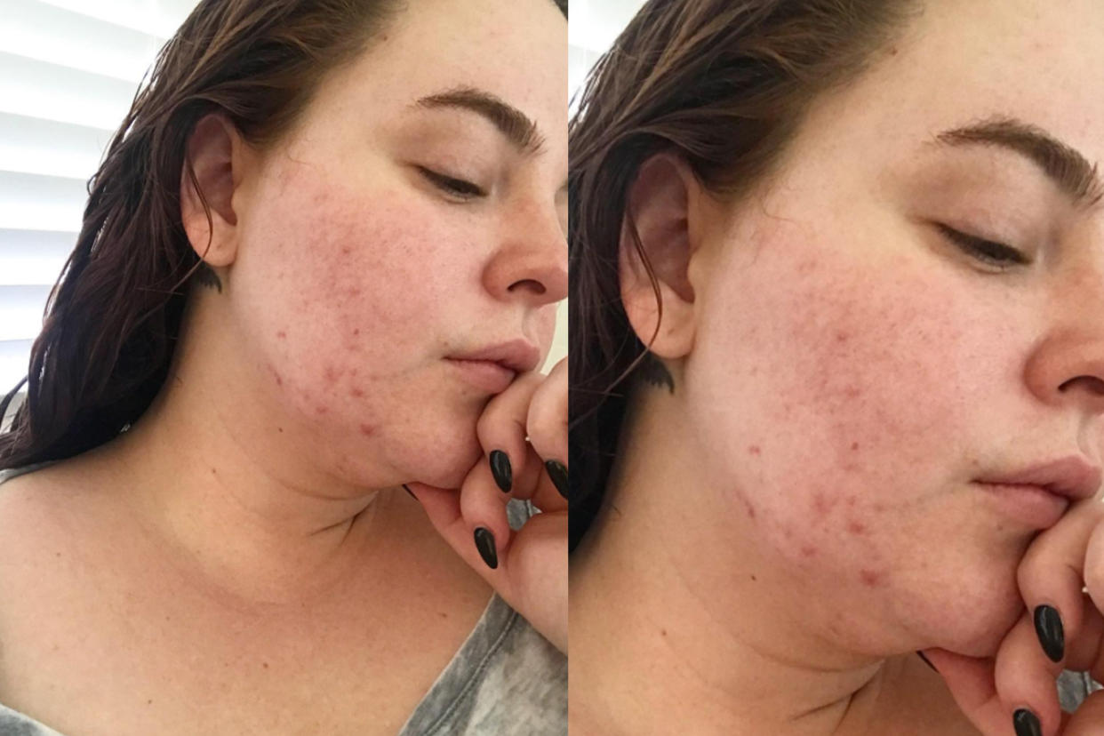 Model Tess Holliday posted a candid photo on Instagram sharing her struggle with acne. (Photo: Instagram/tessholliday)