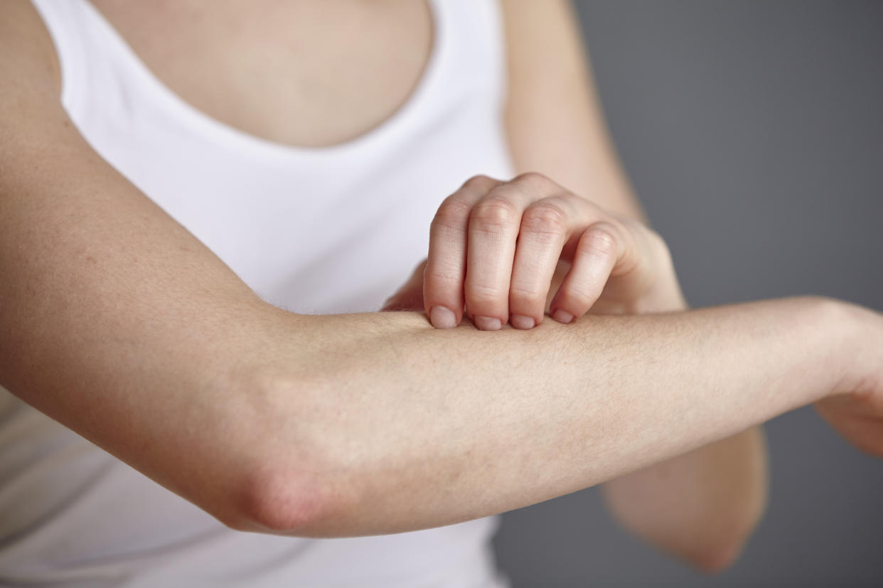 Summertime rash. (Photo: Getty Images)