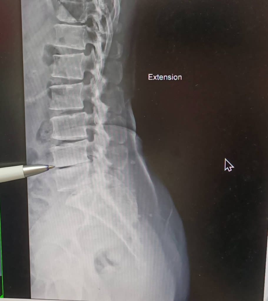 患者劉婦X光術前影像照呈現腰椎第3~4節及薦椎第一節椎間盤狹窄。（記者王正平攝）