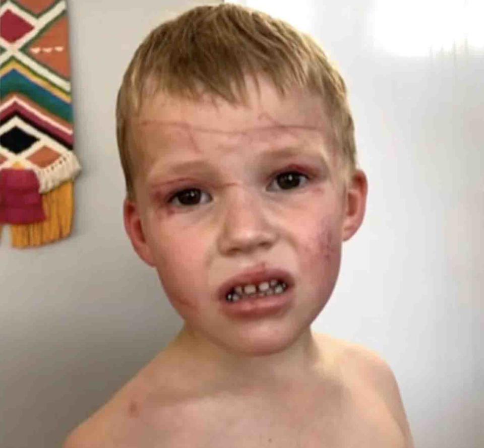 A NSW boy pictured with kangaroo attack injuries. The five-year-old boy suffered cuts to his face and body.