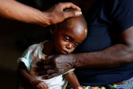 <p>Kaba Bitika Marie, 19 months, an internally displaced and severely acute malnourished child receives medical attention at the Presbyterian hospital in Dibindi zone of Mbuji Mayi in Kasai Oriental Province in the Democratic Republic of Congo, March 16, 2018. (Photo: Thomas Mukoya/Reuters) </p>