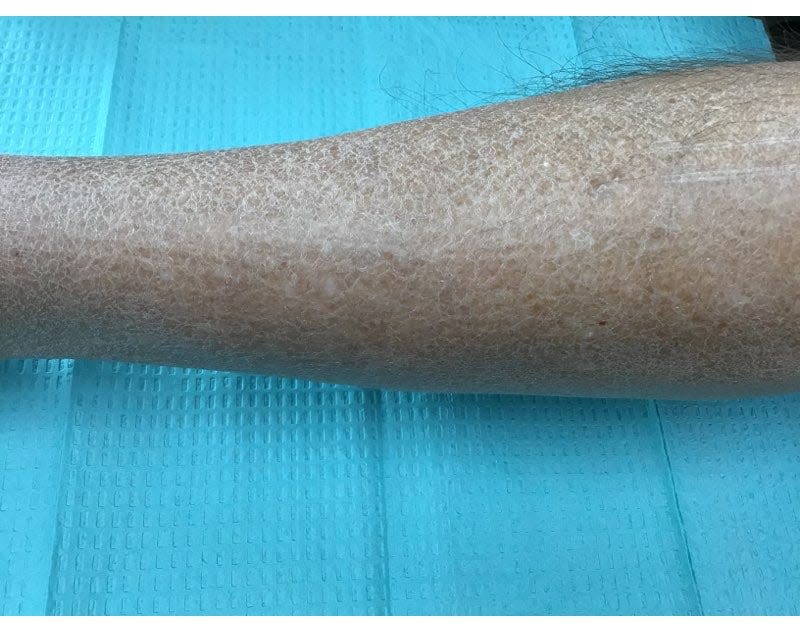 Ichthyosis vulgaris, also known as fish scale skin disease,  often gets worse in winter. It needs a good moisturizer to help the damaged skin barrier.
