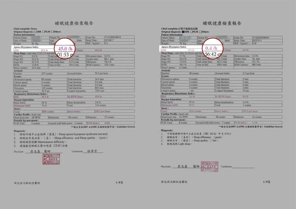 陳男因為打呼被女友建議要去睡眠門診，經檢測後睡眠呼吸中止指數（AHI）高達45（指數高於30即被認定為重度睡眠呼吸中止），因為不想要依賴機器睡眠，故選擇接受正顎手術，術後睡眠呼吸中止指數降為0.4（指數低於5為正常）。