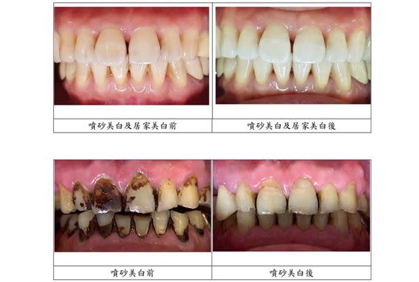 噴砂美白、居家美白前後對照。（圖片／亞東醫院牙科部陳榆惠醫師提供）