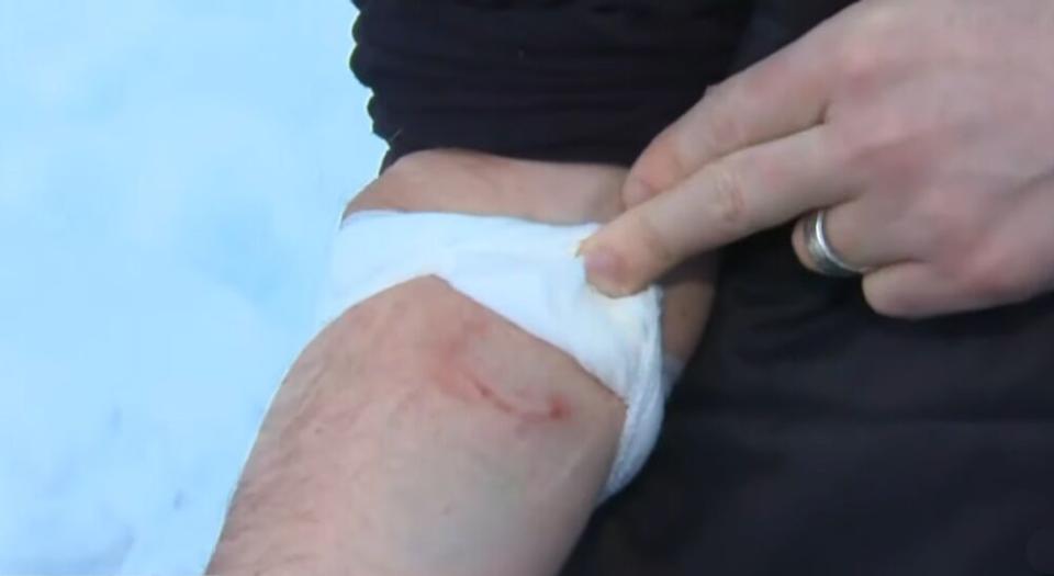 Ian O'Reilly's wound | CBS News
