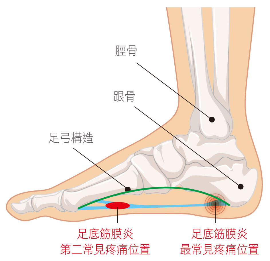 長時間走路可在鞋內加鞋墊，弧度與足弓貼合，緩衝踩地的壓力，避免產生足底筋膜炎。圖／台北市立聯合醫院提供