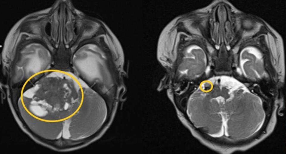 A scan of the tumour in Hugo's brain.