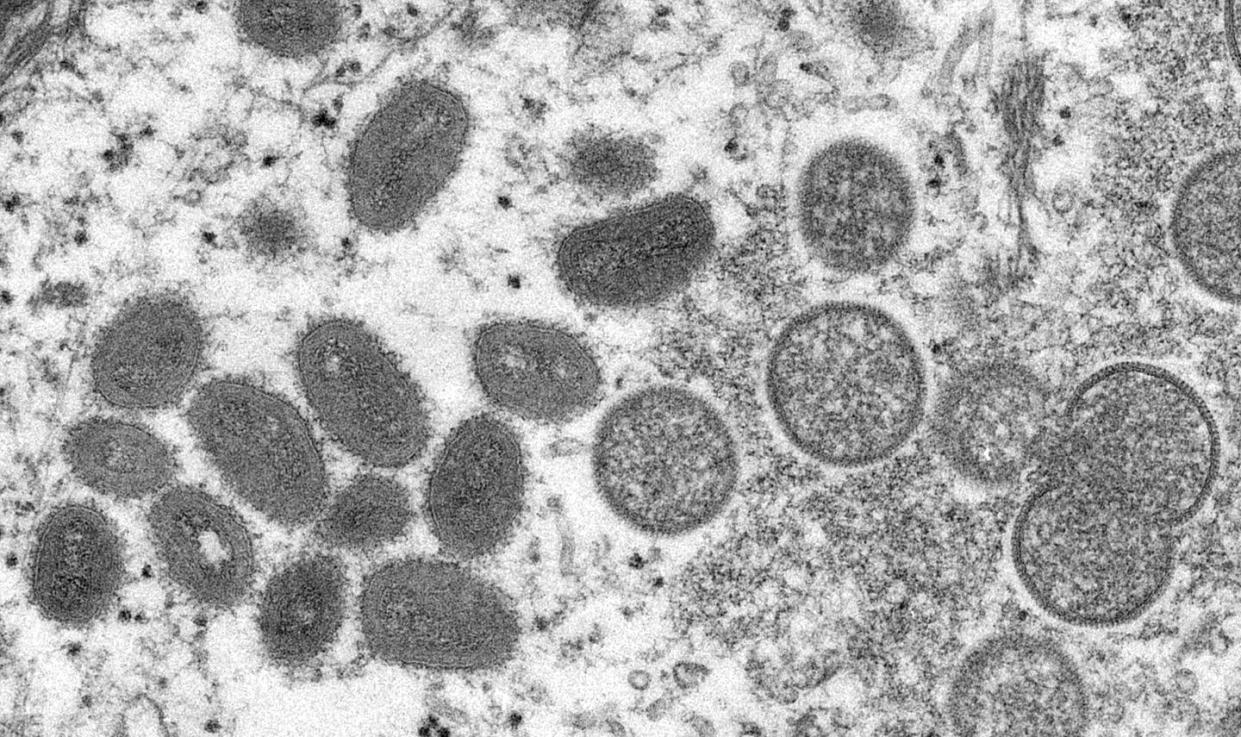 <span>Monkeypox is caused by the monkeypox virus, which are the ovals and circles seen in this electron microscope image of the skin of a person infected with monkeypox.</span> <span><a href="https://phil.cdc.gov/Details.aspx?pid=22664" rel="nofollow noopener" target="_blank" data-ylk="slk:Cynthia S. Goldsmith, Russell Regnery/CDC;elm:context_link;itc:0;sec:content-canvas" class="link ">Cynthia S. Goldsmith, Russell Regnery/CDC</a></span>