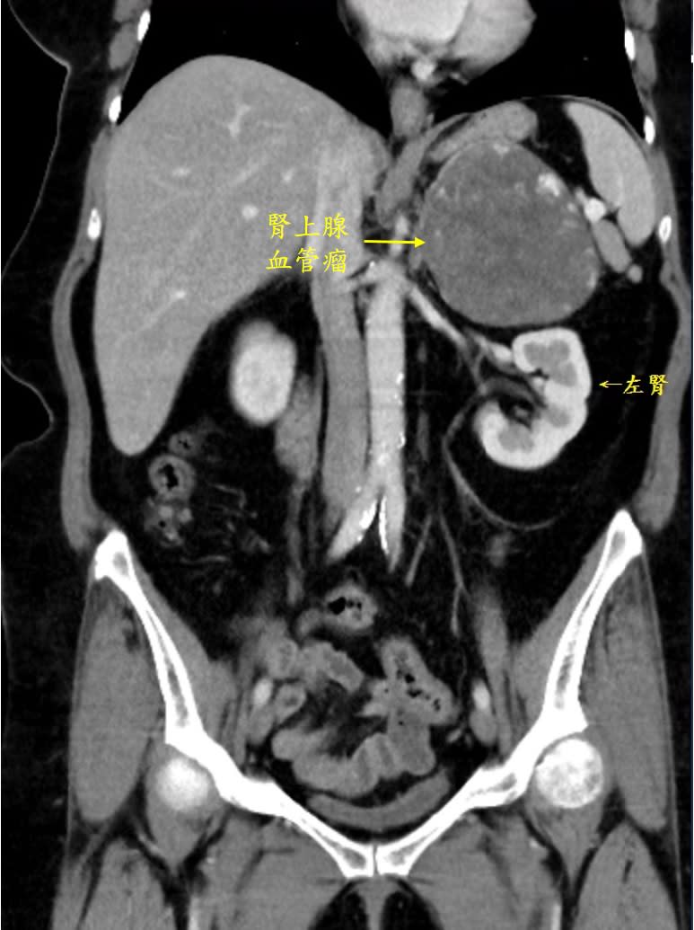 影像檢查上，大如芒果的腎上腺血管瘤。