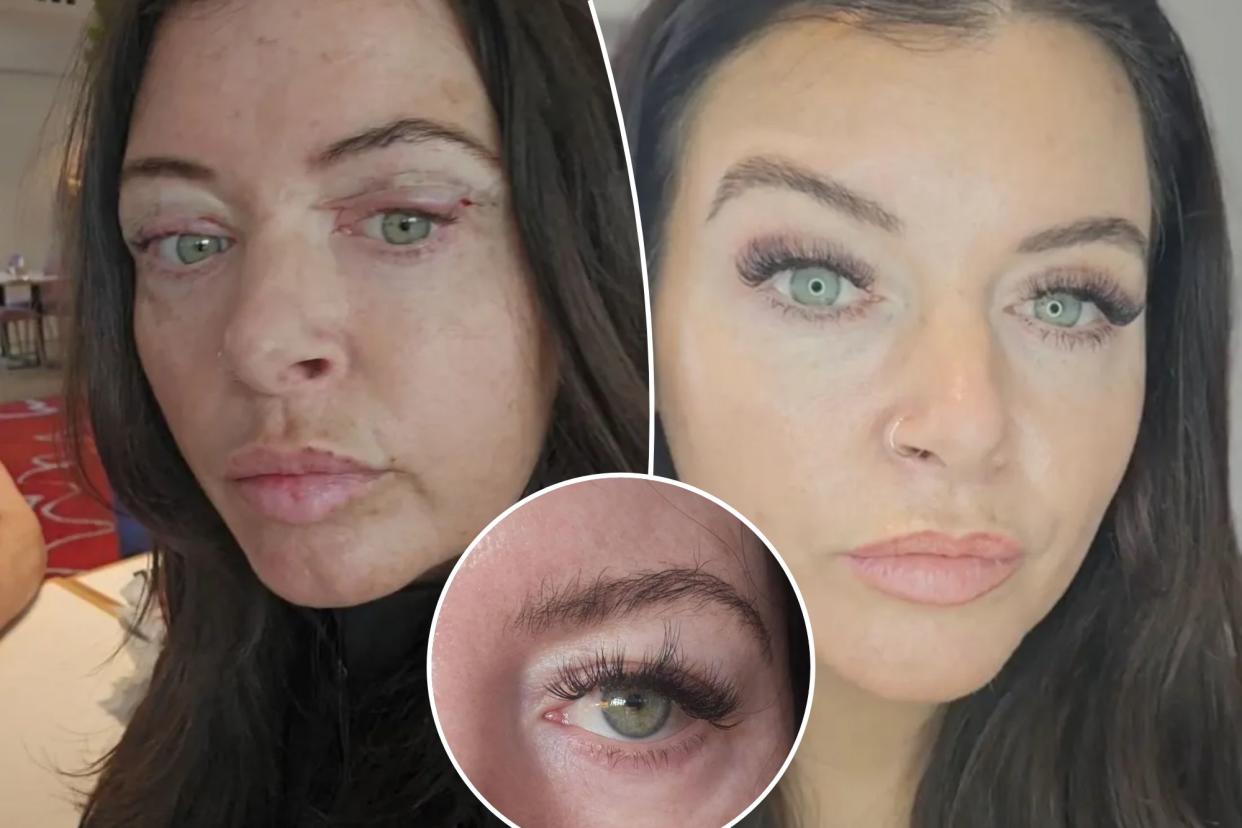 A beautician spent $1.5K on surgery to have her upper eyelids partially removed - so she can apply eyeliner properly. 
