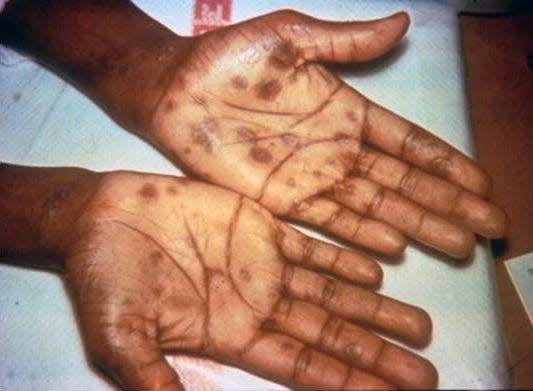 In the second phase, syphilis can present as sores or a rash on places such as the hands.