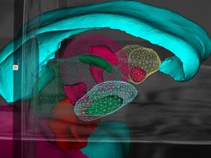 ClearPoint Neuro Maestro Brain Model Fully Automatic Subnuclei Segmentation for DBS