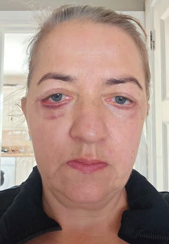 <p>Kennedy News and Media</p> A woman from Ireland who traveled to Turkey for an inexpensive eye lift said it left her looking like a "Basset hound."