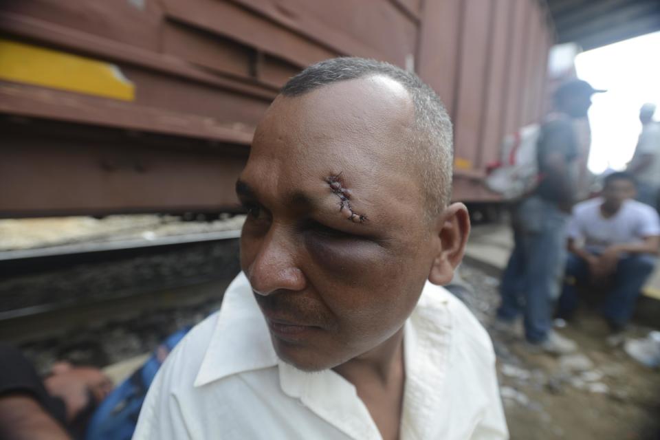 Edwin Omar Fuentes, a migrant from Honduras, stands by the train tracks as he recovers from an injury he got the night before in an altercation over a piece of clothing, in Coatzacoalcos, Mexico, Wednesday, July 11, 2012. Local officials estimate one thousand immigrants are stranded in this town after a rail bridge collapsed blocking the passage of cargo trains used by the travelers heading to the United States. While the number of Mexicans heading to the U.S. has dropped dramatically, a surge of Central American migrants is making the 1,000-mile northbound journey this year, fueled in large part by the rising violence brought by the spread of Mexican drug cartels. (AP Photo/Miguel Juarez)