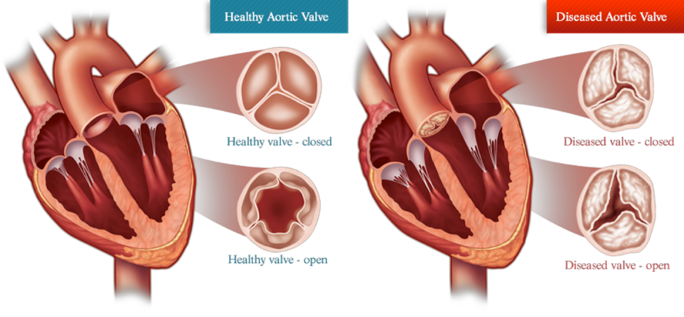 Diagram comparing a heart with a healthy aortic valve and a heart with aortic valve stenosis. The healthy valve opens fully while the diseased valve has a ragged and narrow opening.