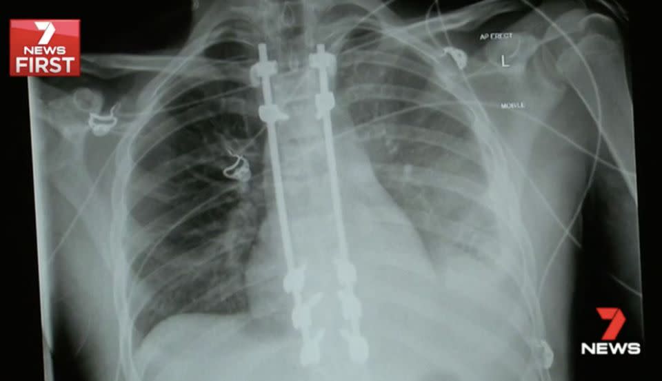 Two metal poles were inserted alongside Ben's spine. Source: 7 News