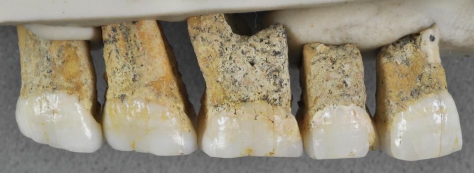 This undated photo provided by the Callao Cave Archaeology Project in April 2019 shows the right upper teeth of the individual CCH6 of the newly discovered species Homo luzonensis. From left are two premolars and 3 molars. In a study released on Thursday, April 10, 2019, scientists report that tests on two samples from the species show minimum ages of 50,000 years and 67,000 years. (Callao Cave Archaeology Project via AP)