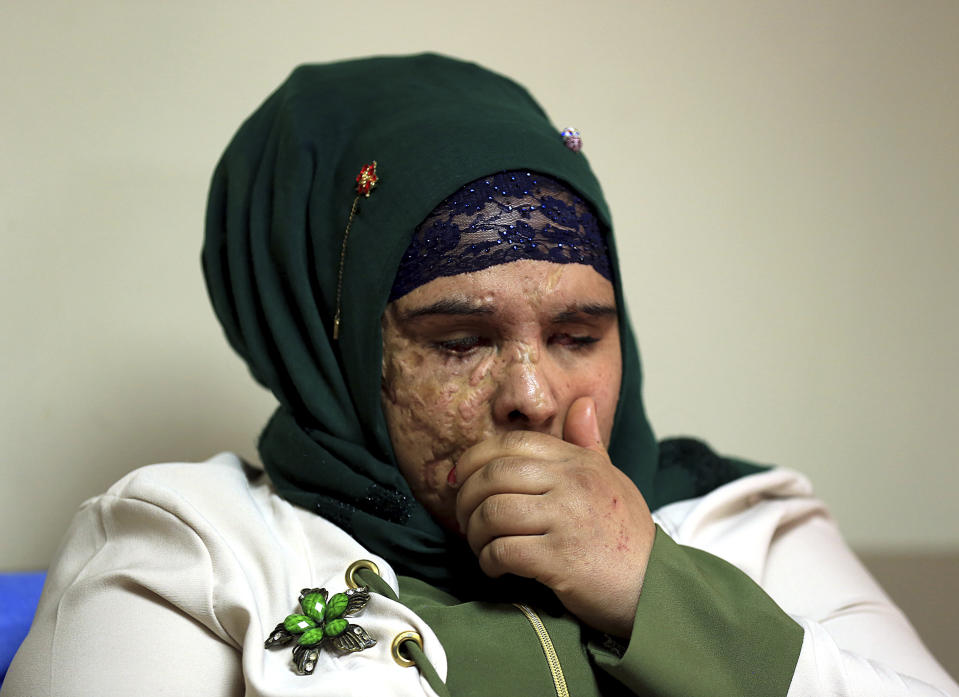 In this Monday, Nov. 5, 2018 photo, Saja Ahmed Saleem, 17, who was injured in an explosion in 2007, talks to The Associated Press before her reconstructive surgery in Baghdad, Iraq. Those whom treatment not available at state-run hospitals and can’t afford treatment at private clinics rely on social media to make appeals that grab attention of some surgeons to help them regain a chance at life. (AP Photo/Hadi Mizban)