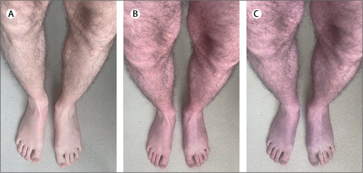 The 33-year-old patient experienced “rapid purple discolouration” on his legs (The Lancet/Manoj Sivan)