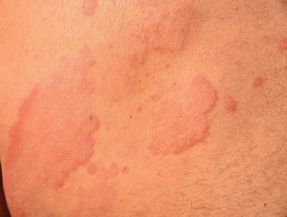 hives, kissing bugs bites, bug bites