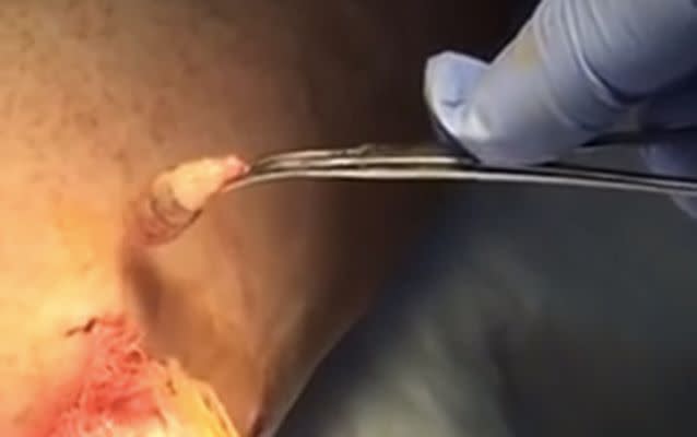 The botfly was pulled out from underneath the man's skin. Source: YouTube/Michael Fussell.