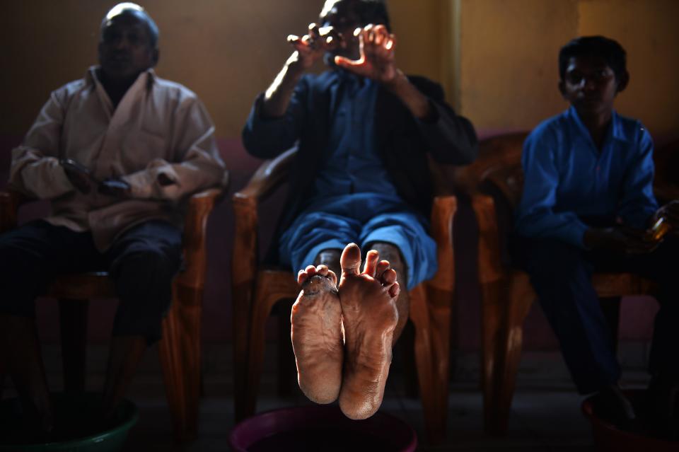 A cured leprosy patient shows his disfigured feet and hands in a leprosy colony in New Delhi, on March 11, 2015. The last decade has seen a resurgence of leprosy in India, which accounts for more than half of the 200,000 new cases worldwide each year. (Photo: Chandan Khanna/AFP/Getty Images)