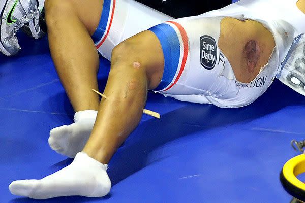 Malaysian cyclist Azizulhasni Awang was recovering on Sunday after surgery to remove a splinter from his leg: AAP Images