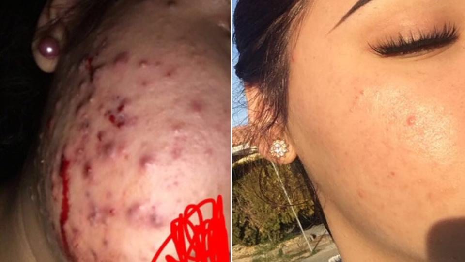 A teen on Twitter named Hilda Paz Robles posted pictures of her cystic acne before and after drinking green tea and honey three times a week. Now, the post is going viral.