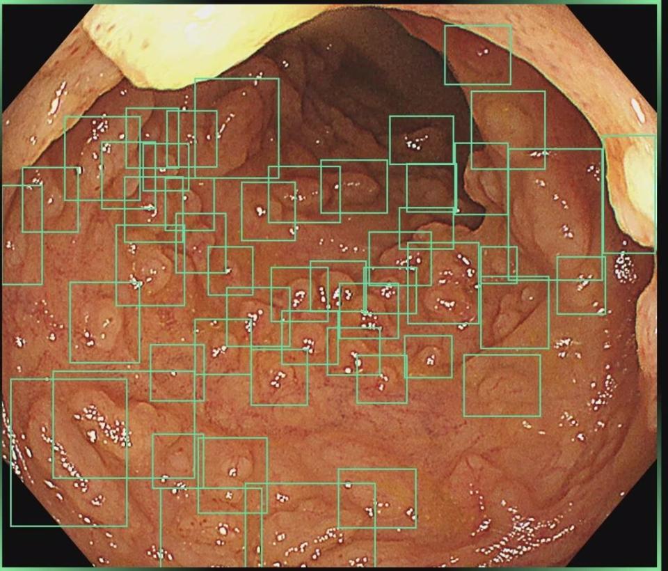 AI大腸鏡照出無數個息肉。（翻攝自胰臟醫師 林相宏 禾馨民權內科診所 臉書）