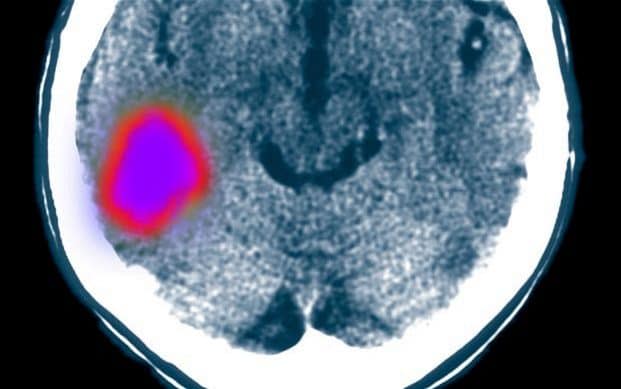 A stroke happens when the blood supply to the brain is cut off, caused by a clot or internal bleeding