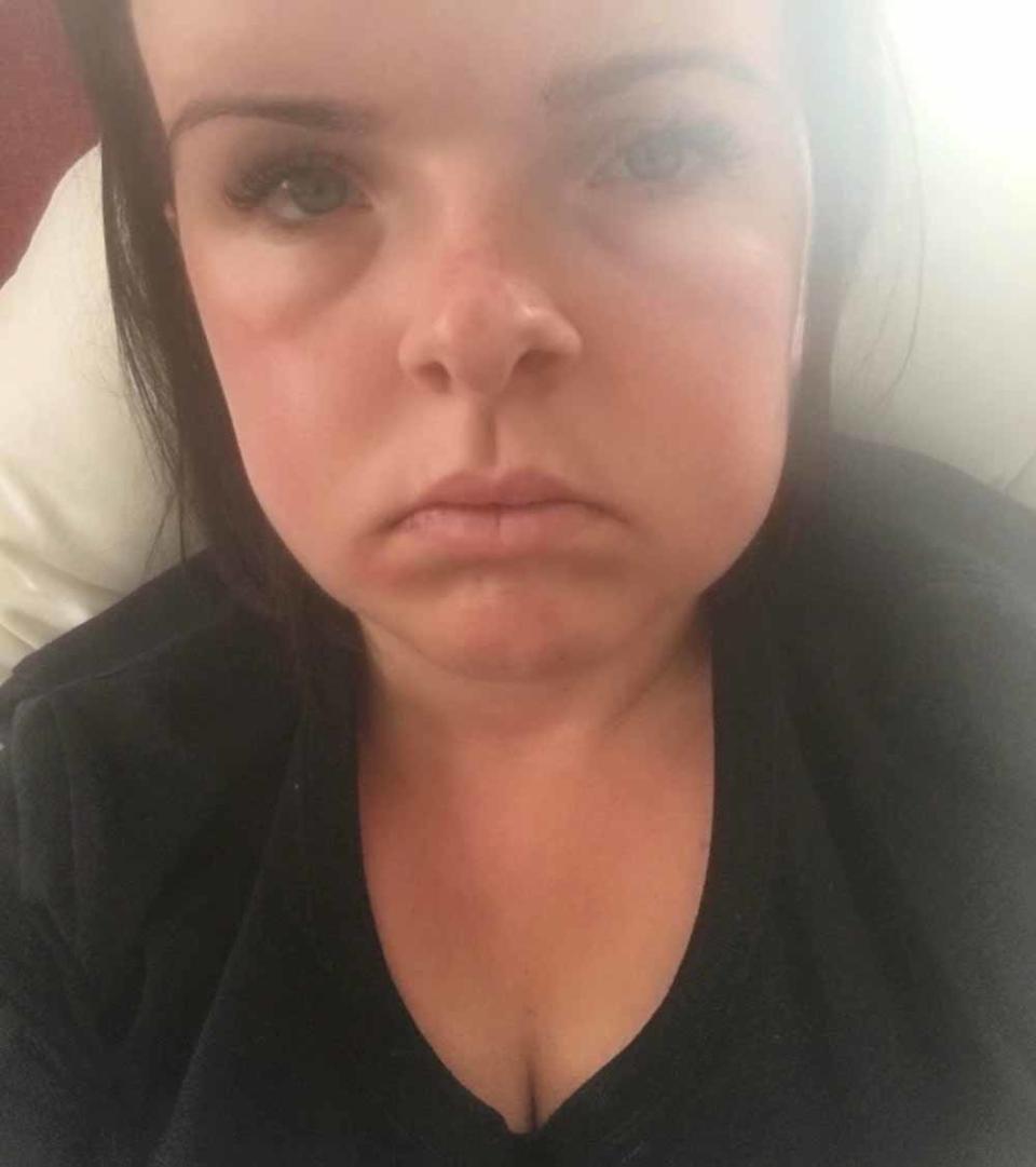 Amy after a jaw operation (PA Real Life)