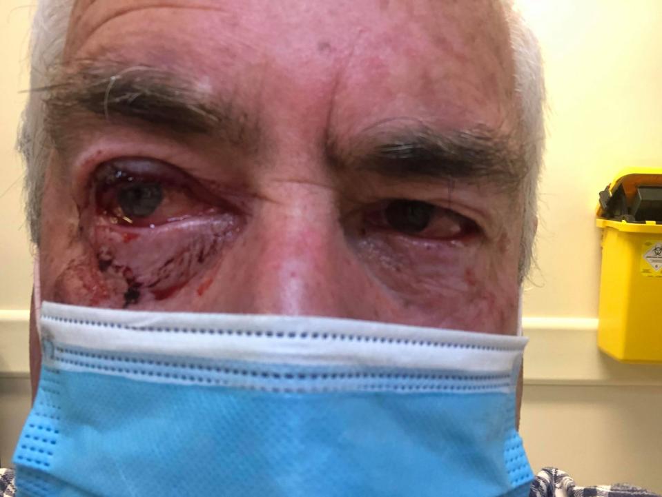 James Glindemann showing eye injuries from a magpie attack. Source: Supplied/ Lorraine MacGillivray