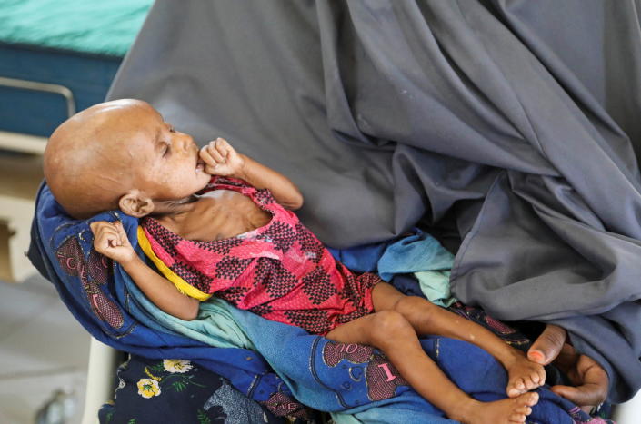 A Somali woman holds her malnourished child 